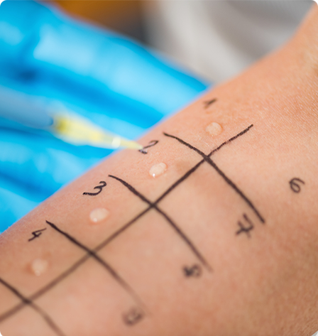 The arm of a patient undergoing allergy testing.