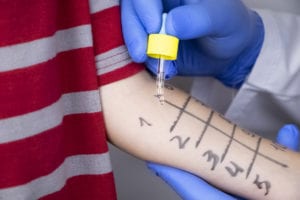 An allergist doctor makes a skin test for allergies. The boy is being examined in the laboratory, waiting for a reaction to allergens.