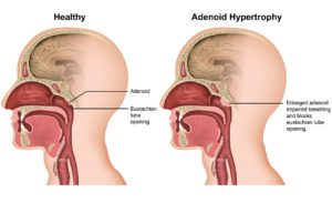 Adenoidectomy graphic