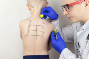 Child at a doctor's appointment. An allergist in the laboratory conducts an allergy prick-test. Skin test for household, food, epidermal allergic reactions. The test is performed on the patient's back.