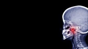 Film X ray : adenoid hypertrophy in obstructive sleep apnea patient