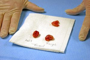 Tonsils and Adenoid with Gloved Hands