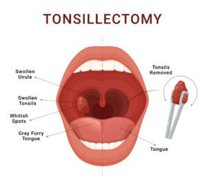 Tonsillectomy scheme removal of palatine tonsils