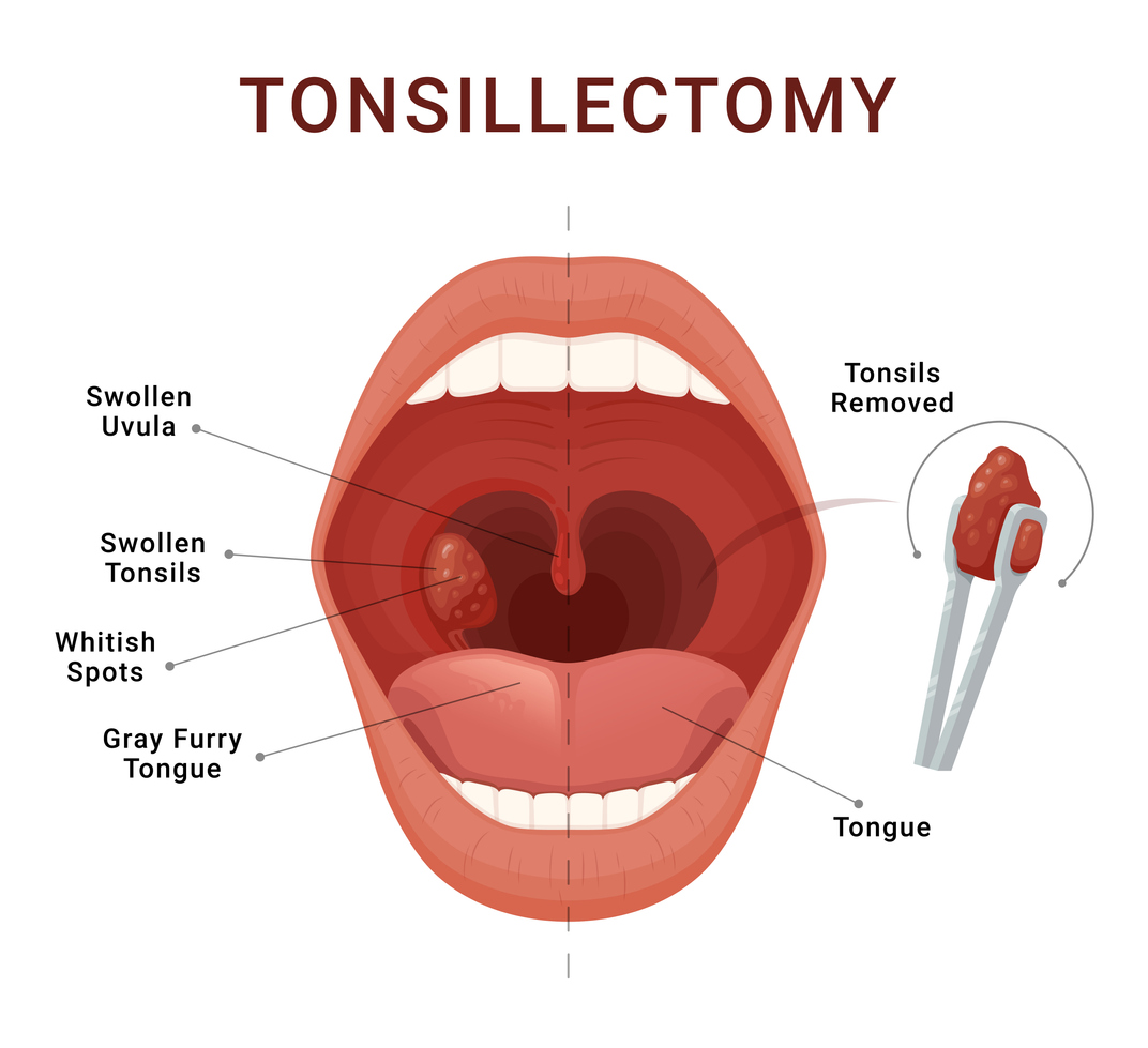 Tonsillectomy Archives - Georgetown Ear, Nose and Throat Center P.A.